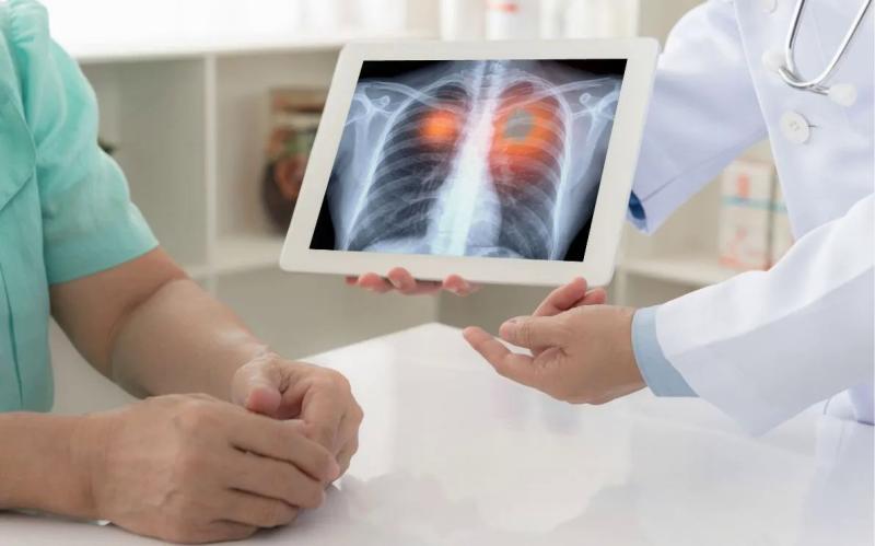 Ung thư phổi không chỉ là câu chuyện của người hút thuốc - Ảnh 1.