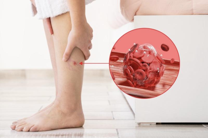 Bất kể giới tính, nếu điều này xuất hiện trên chân, đó có thể là dấu hiệu của cục máu đông trong cơ thể- Ảnh 1.