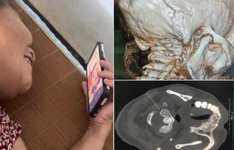 Nghiện xem phim ngắn “trùng sinh, tổng tài”, người phụ nữ 57 tuổi đầu đau “như búa bổ” - Ảnh 2.