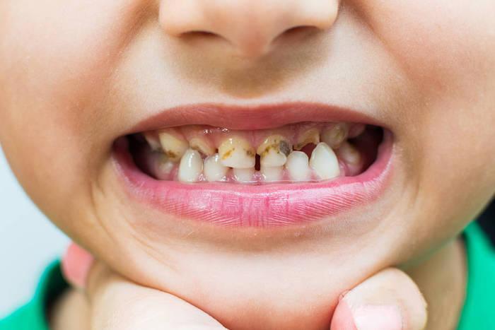 Bé trai 10 tuổi xuất huyết não nghiêm trọng sau khi tự nhổ răng sâu, bác sĩ cảnh báo cha mẹ - Ảnh 1.