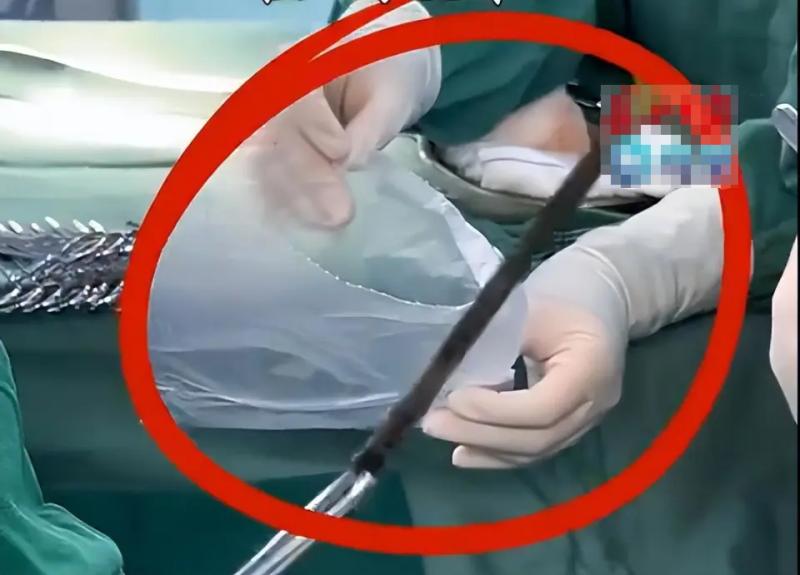 Người đàn ông nuốt chiếc đũa dài 12cm trong phút bốc đồng, 35 năm sau thứ bác sĩ lấy ra là… - Ảnh 1.