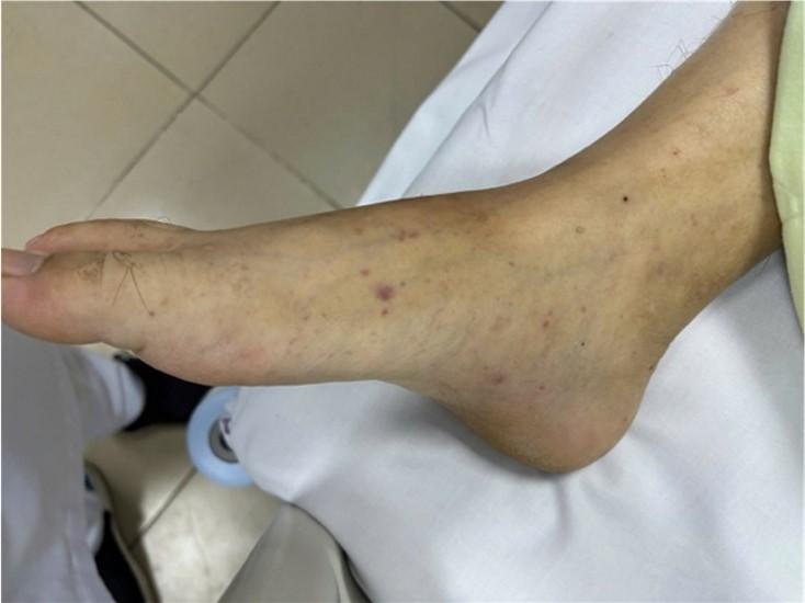 Thêm một ca não mô cầu tại TPHCM, trẻ đã tiêm vaccine vẫn mắc bệnh: Bác sĩ cảnh báo 4 nhóm người có nguy cơ cao - Ảnh 3.