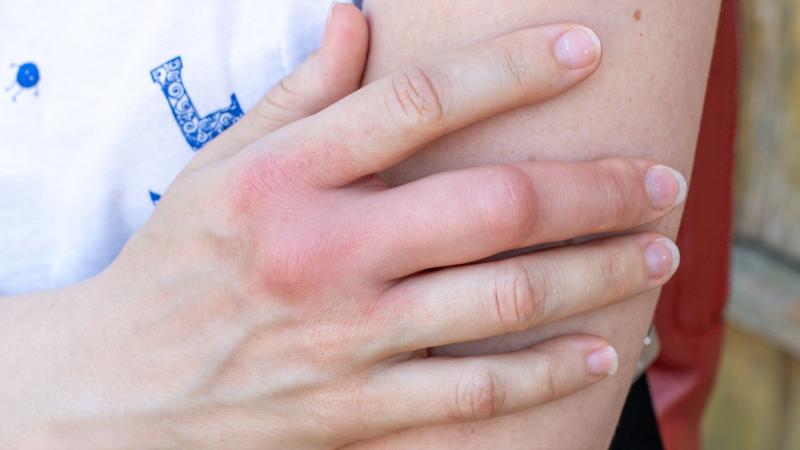 6 bất thường ở ngón tay cảnh báo nhiều bệnh nặng, đặc biệt là ung thư! - Ảnh 3.