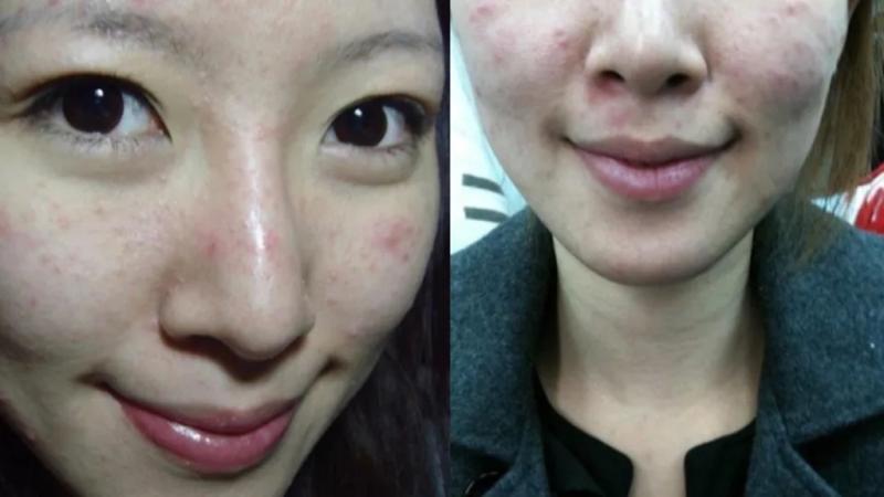 Nữ nghệ sĩ khổ sở vì bệnh da suốt 7 năm, sáng soi gương là bật khóc: Bác sĩ cảnh báo bệnh trứng cá đỏ không chỉ liên quan đến da mặt - Ảnh 2.