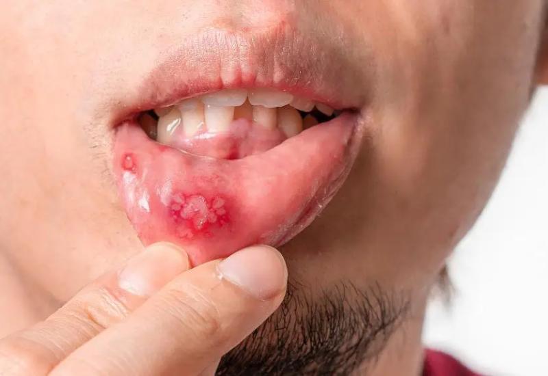 Cơ thể bạn không biết nói dối: 3 dấu hiệu phổ biến của hệ miễn dịch suy yếu, hãy xem bạn có bao nhiêu trong số đó - Ảnh 4.