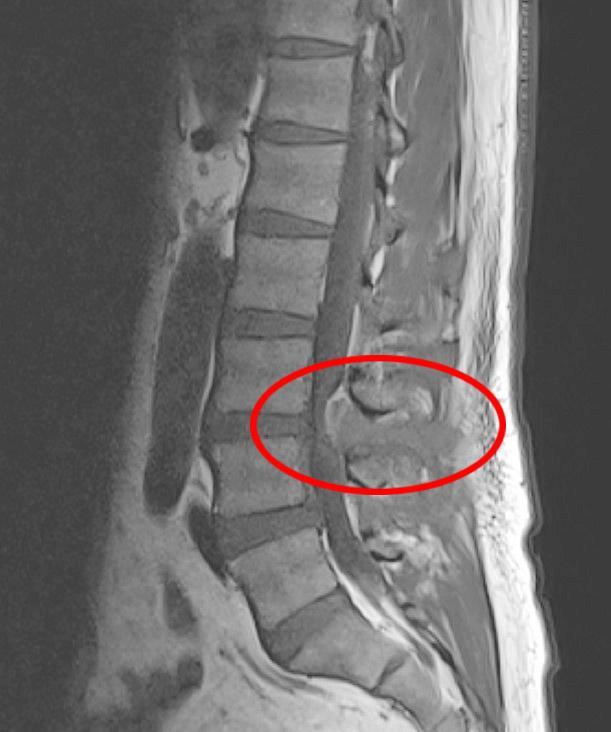 Uống thuốc cúm mãi không khỏi, người đàn ông đi khám phát hiện đốt sống bị vi khuẩn phá hủy - Ảnh 3.