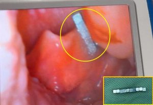 Bé trai gần 4 tuổi khó chịu ở cổ, bố mẹ kinh ngạc khi bác sĩ gắp ra thứ "đáng sợ" bên trong