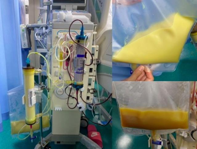 Bé gái 12 tuổi máu "trắng đục như sữa" vì thường xuyên ăn món quen thuộc "vạn người mê" - Ảnh 1.