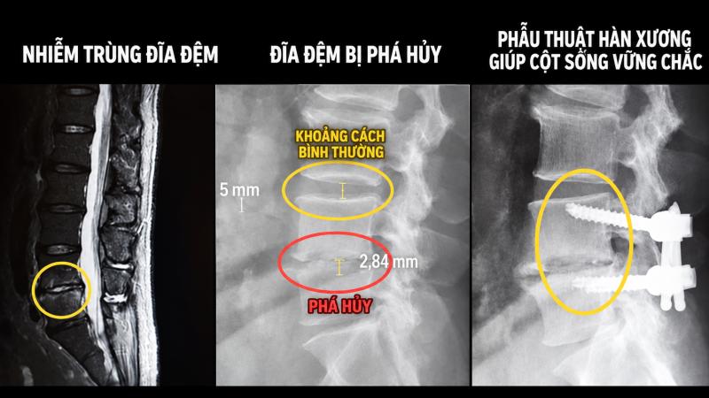 Uống thuốc cúm mãi không khỏi, người đàn ông đi khám phát hiện đốt sống bị vi khuẩn phá hủy - Ảnh 1.