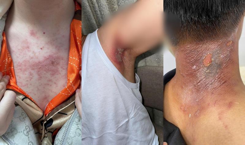 Kiến ba khoang "vào mùa", cẩn trọng dễ nhầm với zona thần kinh - Ảnh 1.