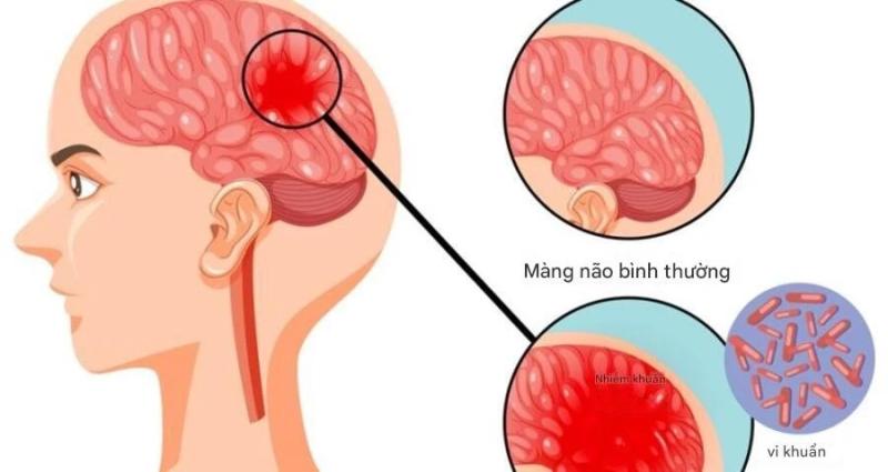 Bệnh não mô cầu có thể diễn tiến nhanh, cần đặc biệt chú ý 4 dấu hiệu này - Ảnh 1.