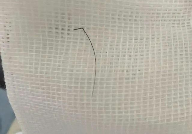 Người phụ nữ ngứa tai đi khám, bác sĩ phát hiện thứ bất ngờ bên trong- Ảnh 2.