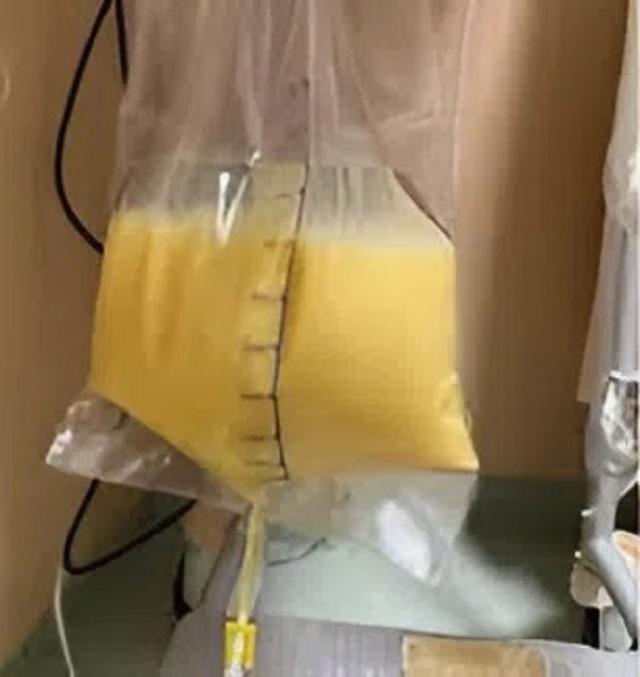 Người phụ nữ 30 tuổi "máu trắng đục như sữa" vì thói quen nhiều người mắc mà không hay- Ảnh 1.