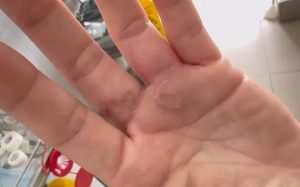 Mùa mưa, cảnh giác nguy cơ nhiễm ký sinh trùng, giun sán