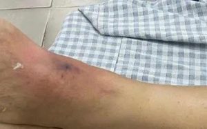 Liên tiếp các trường hợp rết cắn phải nhập viện